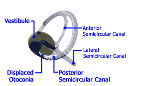 Epley or Semont Maneuver